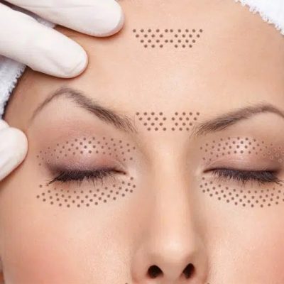 traitement plasma visage_guadeloupe